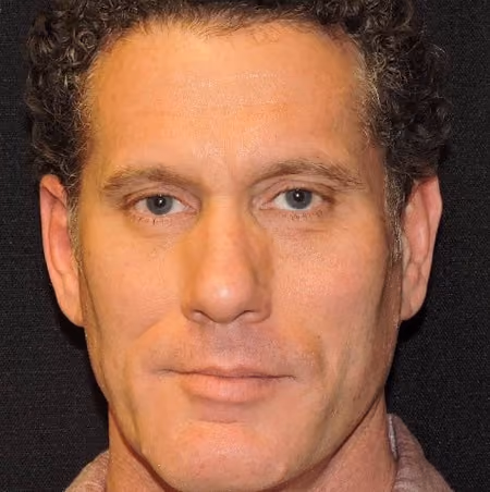 Ear Reshaping after photo, case 2177 - Cool Springs Plastic Surgery