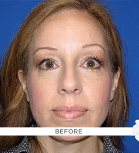 Eyelid Surgery before photo, case 2219 - Cool Springs Plastic Surgery