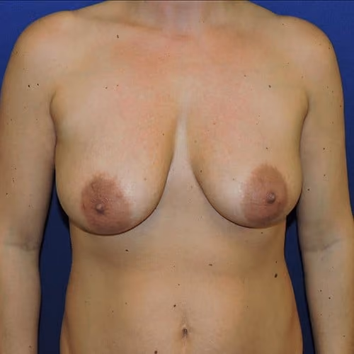 Breast Lift + Augmentation before photo, case 2315 - Cool Springs Plastic Surgery