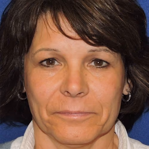 Eyelid Surgery before photo, case 2645 - Cool Springs Plastic Surgery