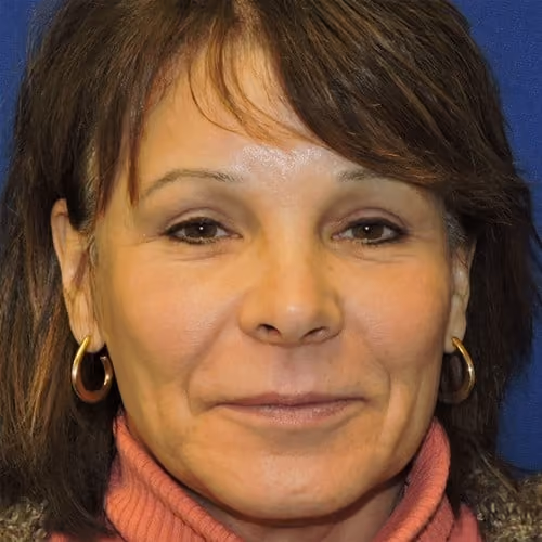 Eyelid Surgery after photo, case 2645 - Cool Springs Plastic Surgery