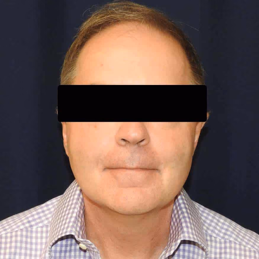 Liposuction after photo, case 2659 - Cool Springs Plastic Surgery