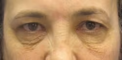 Eyelid Surgery before photo, case 2957 - Cool Springs Plastic Surgery