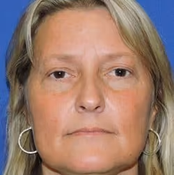 Eyelid Surgery before photo, case 2972 - Cool Springs Plastic Surgery