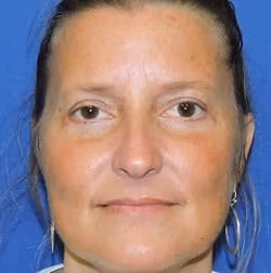 Eyelid Surgery after photo, case 2972 - Cool Springs Plastic Surgery