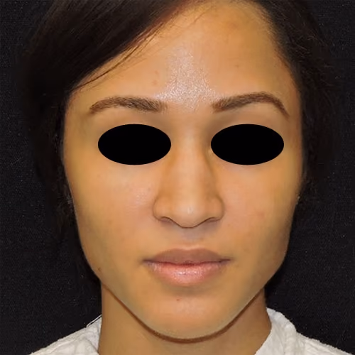 Rhinoplasty before photo, case 3093 - Cool Springs Plastic Surgery