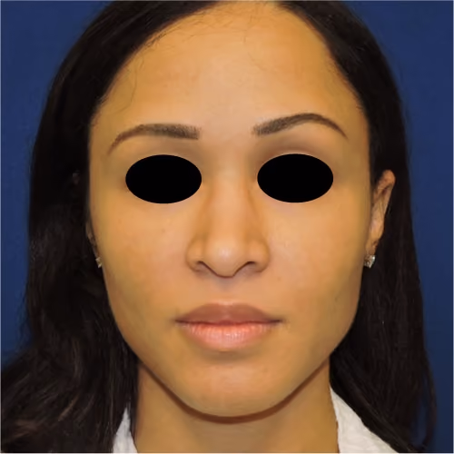 Rhinoplasty after photo, case 3093 - Cool Springs Plastic Surgery