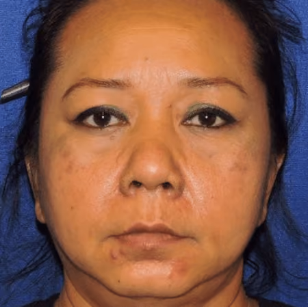 Eyelid Surgery before photo, case 3146 - Cool Springs Plastic Surgery