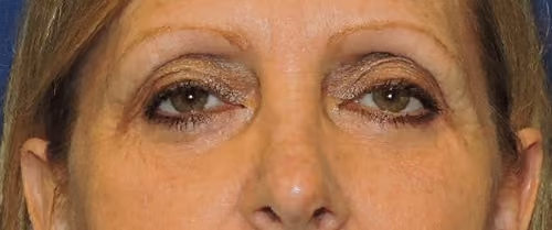 Eyelid Surgery after photo, case 3259 - Cool Springs Plastic Surgery
