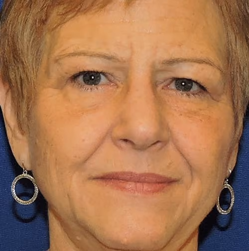 Eyelid Surgery before photo, case 3308 - Cool Springs Plastic Surgery