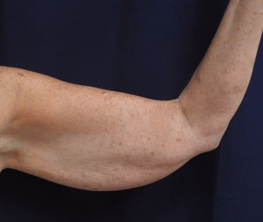 Arm Lift / Brachioplasty before photo, case 501 - Cool Springs Plastic Surgery