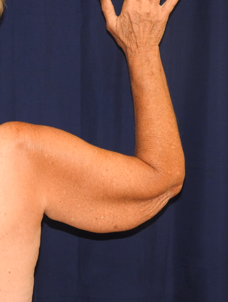Arm Lift / Brachioplasty before photo, case 506 - Cool Springs Plastic Surgery
