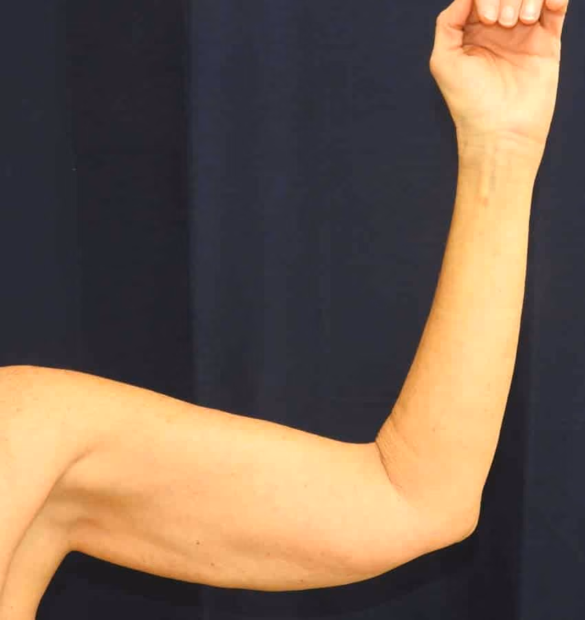 Arm Lift / Brachioplasty before photo, case 6416 - Cool Springs Plastic Surgery