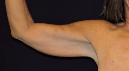 Arm Lift / Brachioplasty before photo, case 6506 - Cool Springs Plastic Surgery