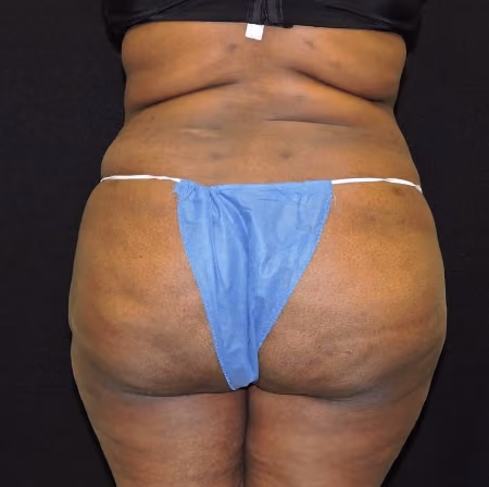 Brazilian Butt Lift after photo, case 6929 - Cool Springs Plastic Surgery