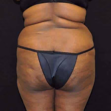Brazilian Butt Lift before photo, case 6929 - Cool Springs Plastic Surgery