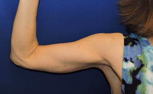 Arm Lift / Brachioplasty after photo, case 7060 - Cool Springs Plastic Surgery