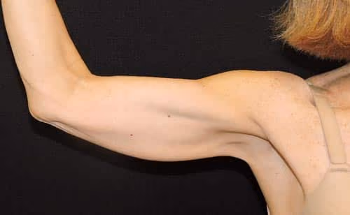 Arm Lift / Brachioplasty before photo, case 7060 - Cool Springs Plastic Surgery