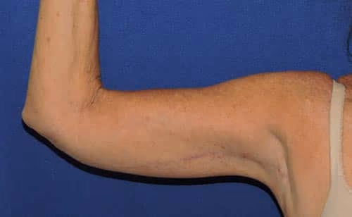 Arm Lift / Brachioplasty after photo, case 7224 - Cool Springs Plastic Surgery