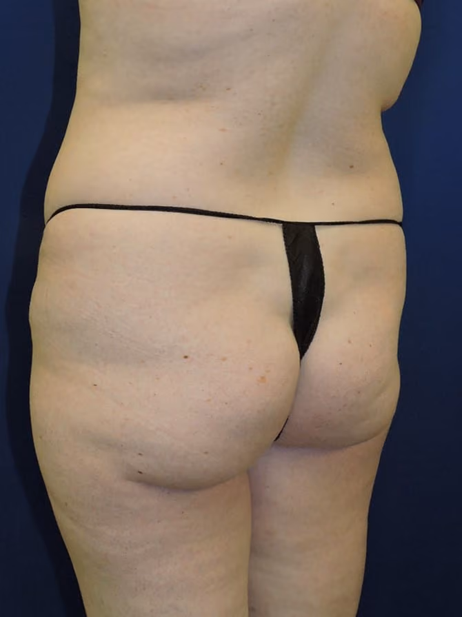 Brazilian Butt Lift before photo, case 7747 - Cool Springs Plastic Surgery