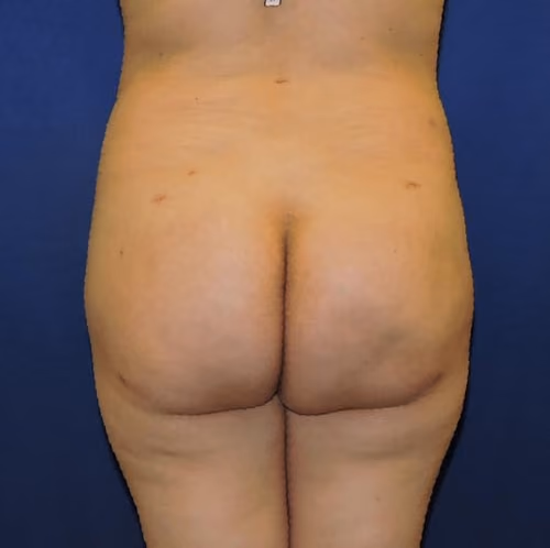 Brazilian Butt Lift after photo, case 7937 - Cool Springs Plastic Surgery