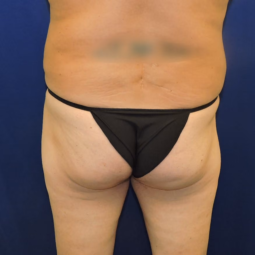 Brazilian Butt Lift before photo, case 8007 - Cool Springs Plastic Surgery