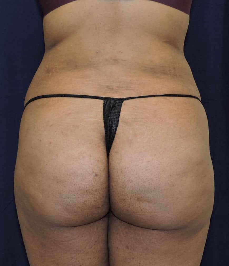 Brazilian Butt Lift before photo, case 8371 - Cool Springs Plastic Surgery