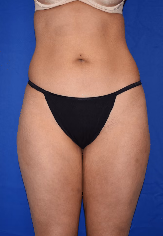 Liposuction before photo, case 6647 - Cool Springs Plastic Surgery