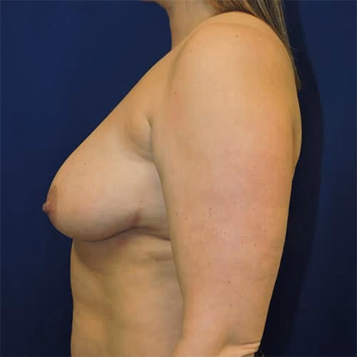 Breast Lift before and after, case 1739 - Cool Springs Plastic Surgery