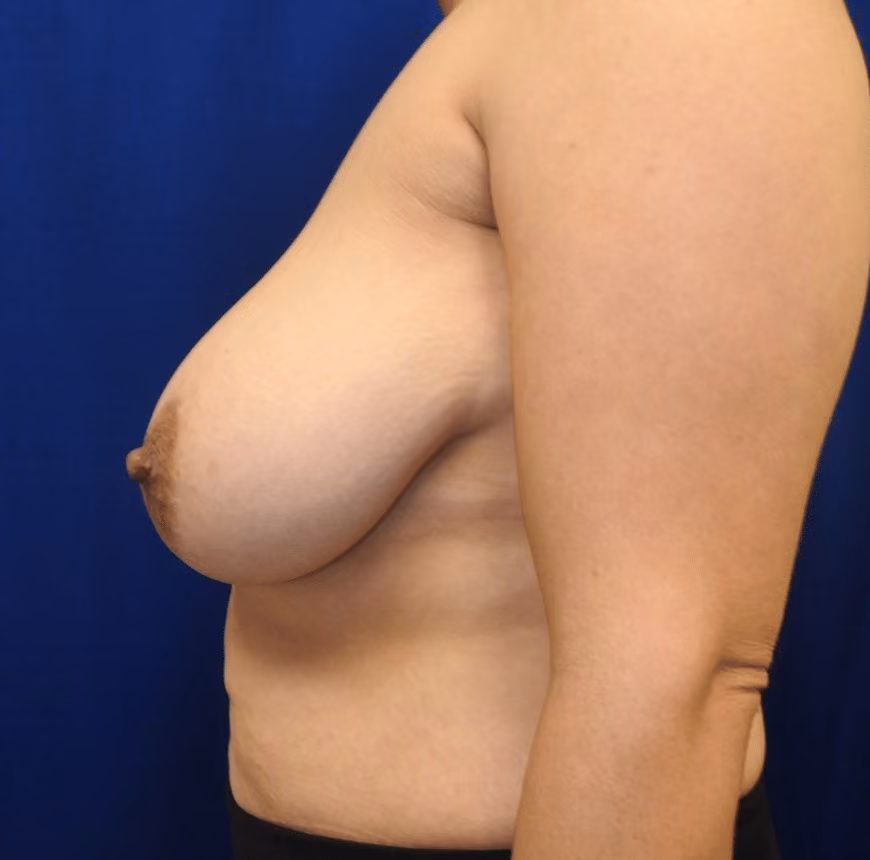 Mommy Makeover before and after, case 6834 - Cool Springs Plastic Surgery