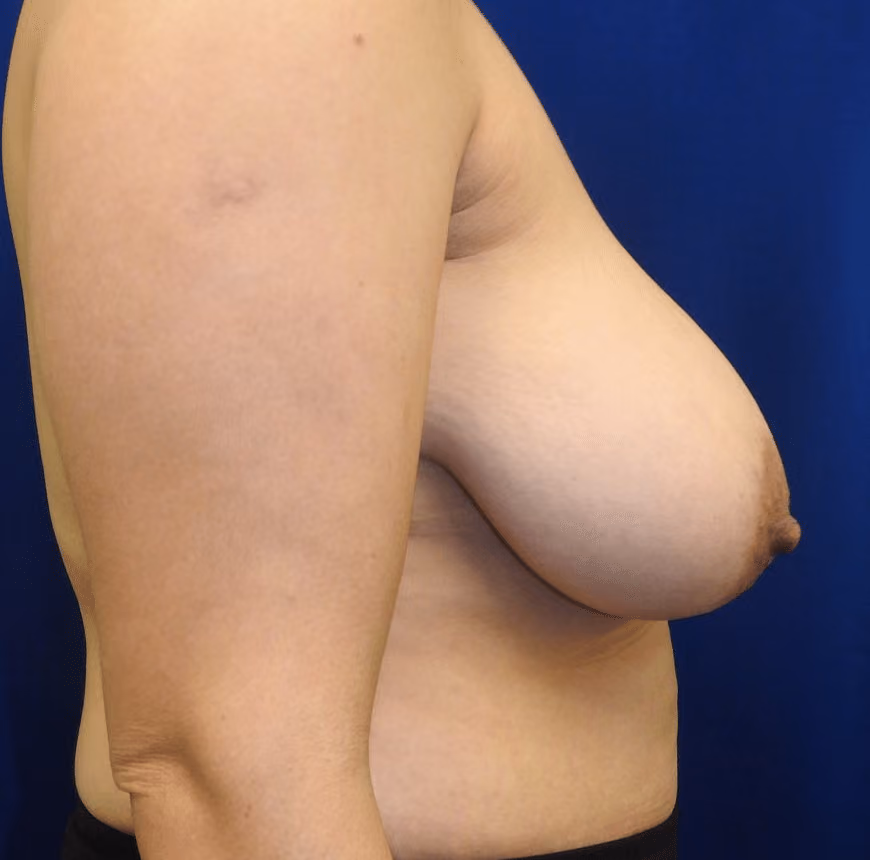 Mommy Makeover before and after, case 6834 - Cool Springs Plastic Surgery