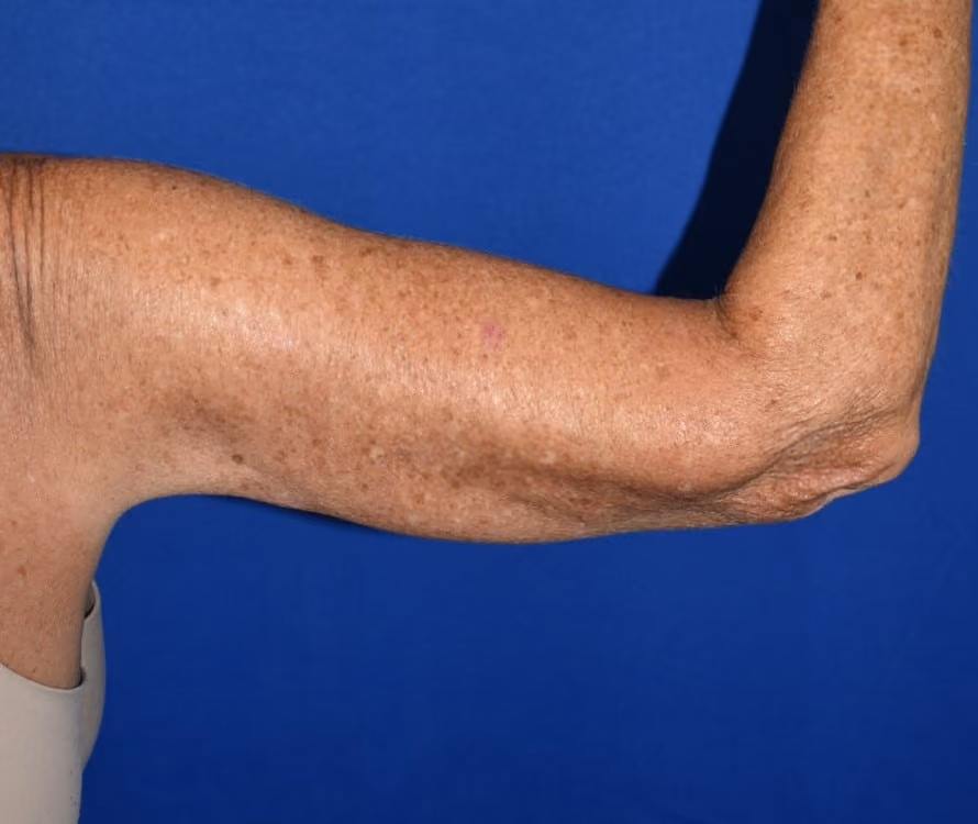 Arm Lift / Brachioplasty before and after, case 501 - Cool Springs Plastic Surgery