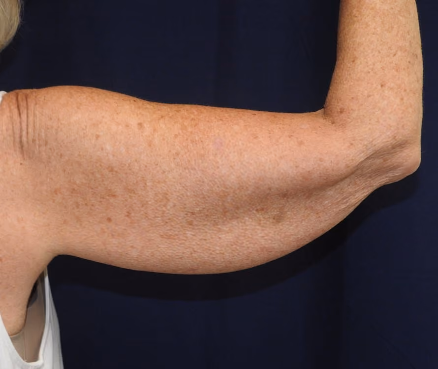 Arm Lift / Brachioplasty before and after, case 501 - Cool Springs Plastic Surgery