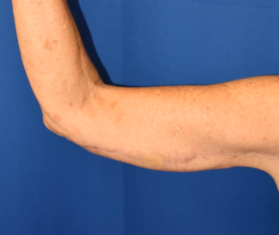 Arm Lift / Brachioplasty before and after, case 501 - Cool Springs Plastic Surgery