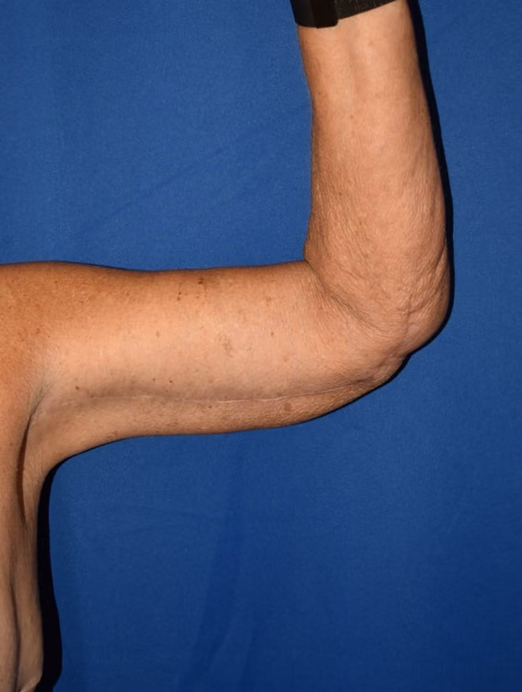 Arm Lift / Brachioplasty before and after, case 506 - Cool Springs Plastic Surgery