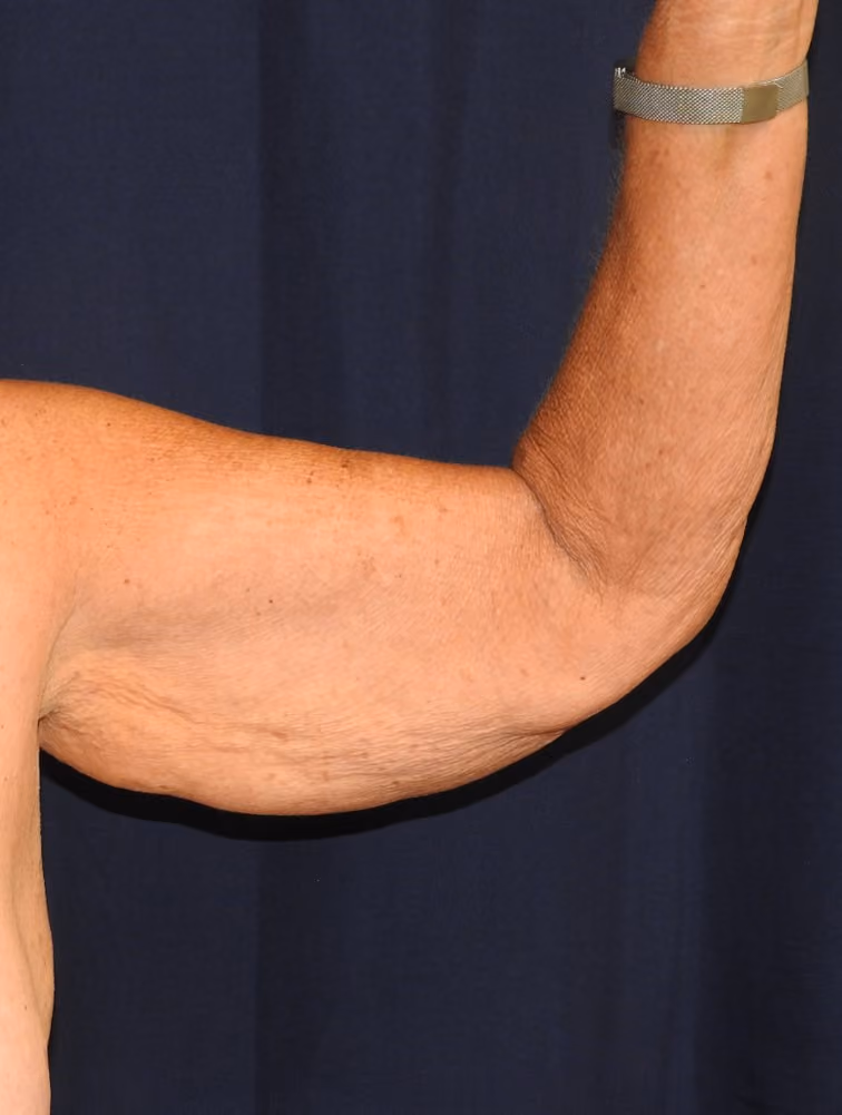Arm Lift / Brachioplasty before and after, case 506 - Cool Springs Plastic Surgery