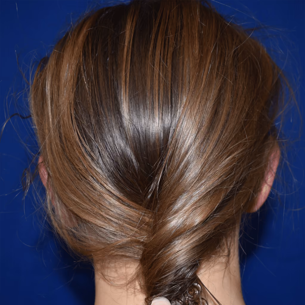 Ear Reshaping before and after, case 1511 - Cool Springs Plastic Surgery