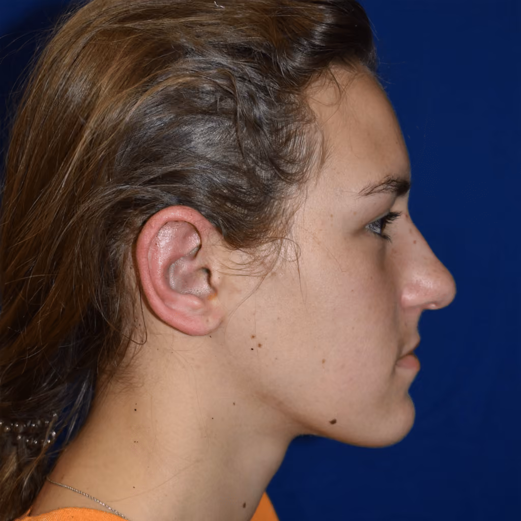 Ear Reshaping before and after, case 1511 - Cool Springs Plastic Surgery