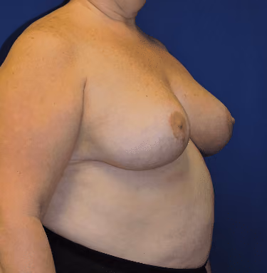 Breast Reduction before and after, case 1633 - Cool Springs Plastic Surgery