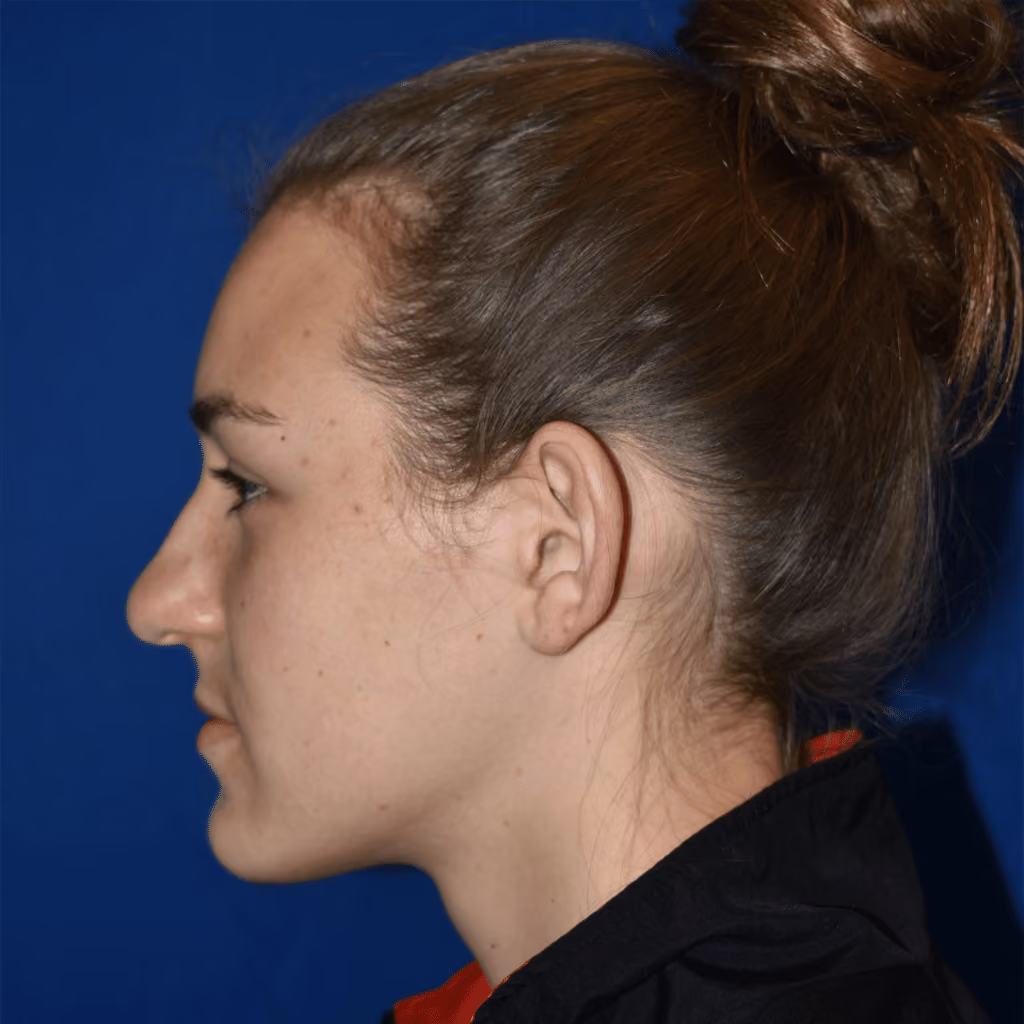 Ear Reshaping before and after, case 1511 - Cool Springs Plastic Surgery