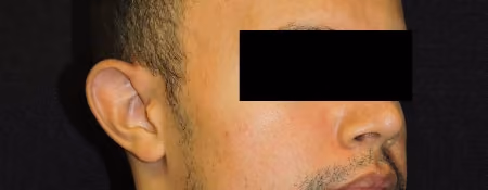 Ear Reshaping before and after, case 1970 - Cool Springs Plastic Surgery