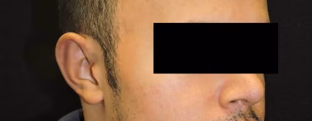 Ear Reshaping before and after, case 1970 - Cool Springs Plastic Surgery