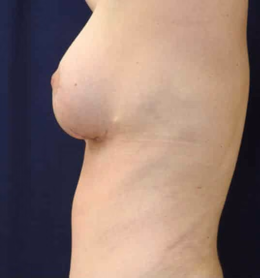 Breast Reduction before and after, case 1874 - Cool Springs Plastic Surgery