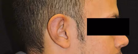 Ear Reshaping before and after, case 1970 - Cool Springs Plastic Surgery