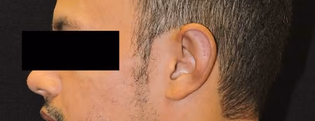 Ear Reshaping before and after, case 1970 - Cool Springs Plastic Surgery