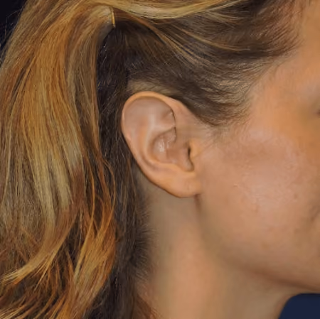 Ear Reshaping before and after, case 2034 - Cool Springs Plastic Surgery