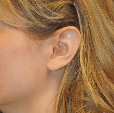 Ear Reshaping before and after, case 2034 - Cool Springs Plastic Surgery