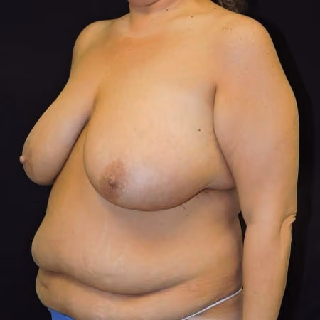Breast Reduction before and after, case 1668 - Cool Springs Plastic Surgery
