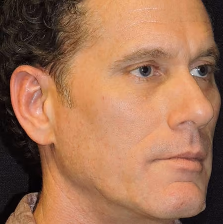 Ear Reshaping before and after, case 2177 - Cool Springs Plastic Surgery