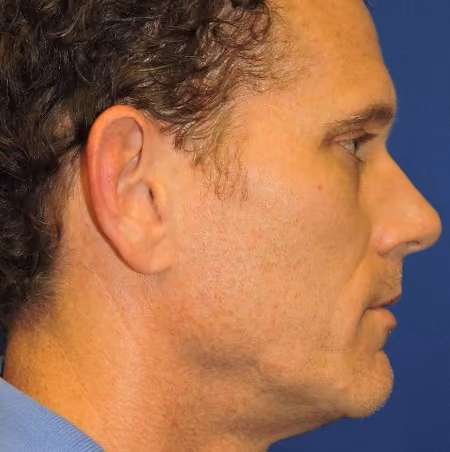 Ear Reshaping before and after, case 2177 - Cool Springs Plastic Surgery